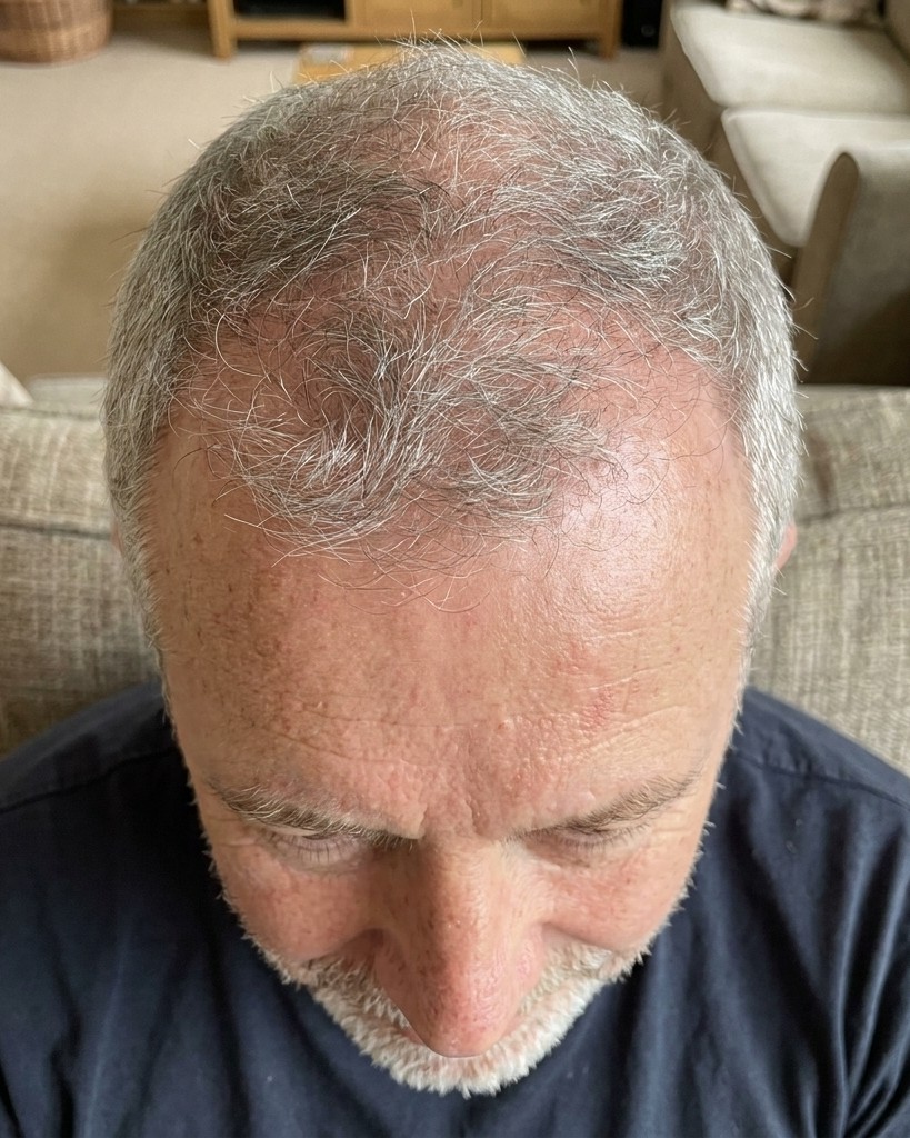 Tom B. hairline, week 2